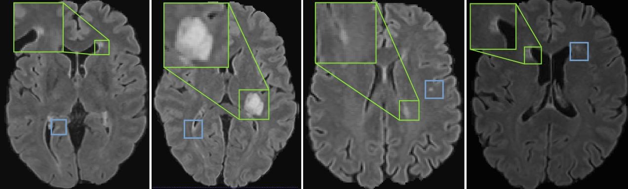 Original MICCAI 2023 Figure 3: multiple sclerosis MRI with green boxes for selected lesions and blue boxes for discarded lesions