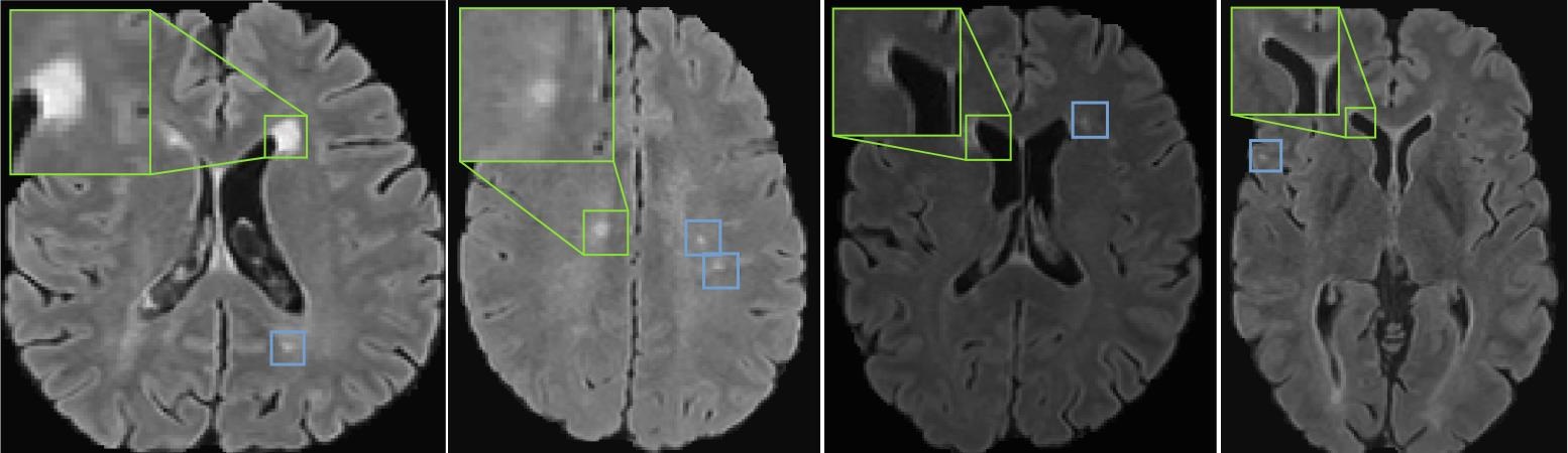 Original MICCAI 2023 supplementary Figure 5: examples of salient lesions selected by the self-pruning module